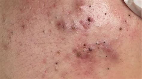 This truly revolting footage shows huge blackheadsbeing removed from a man's back. . Bubuplus blackheads 2021